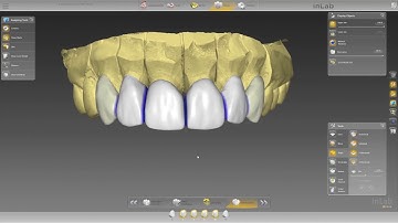 inLab Software: Managing Anterior Angles with Hotkeys