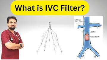 IVC Filter: What You Need to Know
