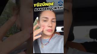 Buse Varol'un Yüzünde Yürüyen Bakteri Çıktı!!  #shorts