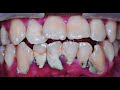 20 yo. Male&#39;s Teeth | Tartar | Scaling | Dentist | Dokter Gigi Tri Putra