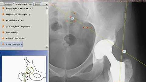 TraumaCad - Stem Version
