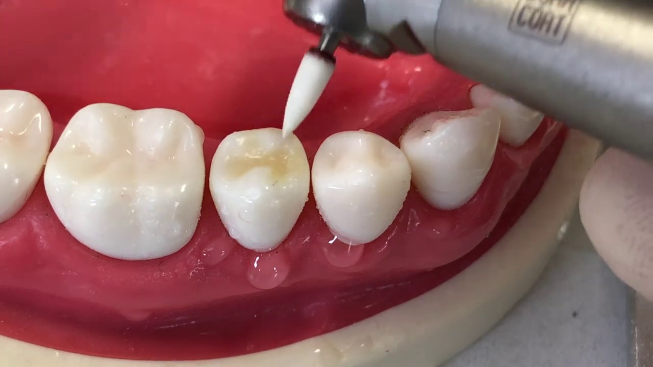 歯 と 歯 の あいだ の 虫歯 レジン