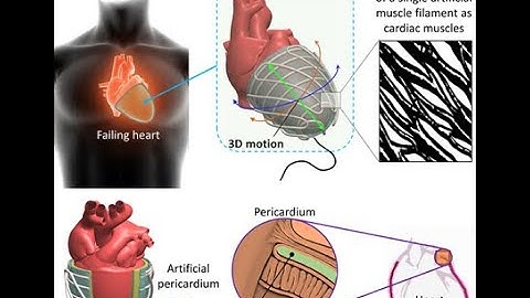 Robotic Cardiac Compression Device for the Treatment of Heart Failure