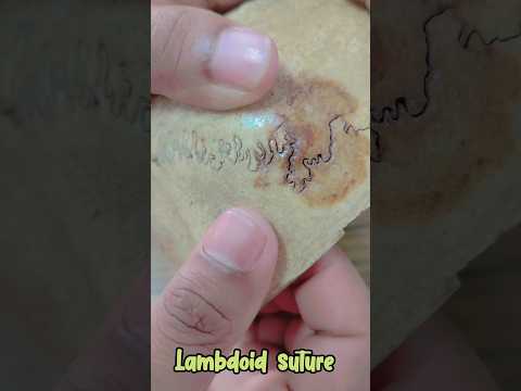 Vidéo: Où se trouve la suture lambdoïde ?