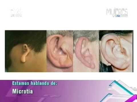 Vídeo: ¿Qué Es Microtia? Imágenes, Tipos, Tratamiento Y Cirugía