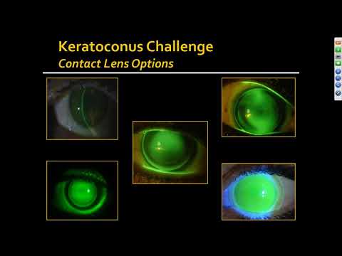 [Online Seminar] Keratoconus