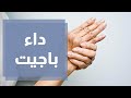 أسباب وأعراض داء باجيت في العظام أسباب وأعراض داء باجيت في العظام