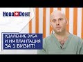 Одномоментная имплантация зубов видео. 👏 Уникальные возможности одномоментной имплантации зубов.12+