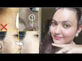 घर पर MOLE मस्से तिल Skin Tags, Brown / Dark Spots को खत्म करने का सबसे असरदार तरीका |Mole Removal