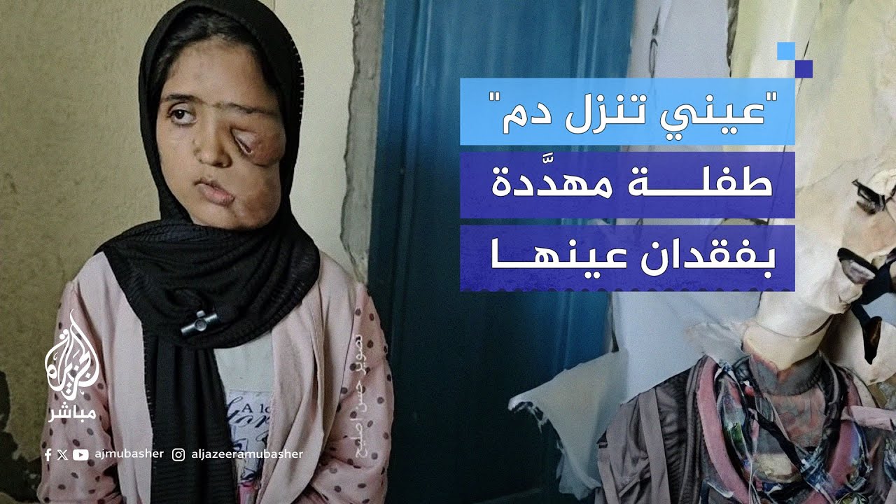 السرطان أفقدها عينها.. مناشدة الفتاة انشراح المدني عبر الجزيرة مباشر للعلاج خارج غزة