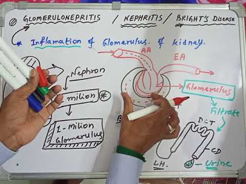 Glomerulonephritis | Bright&rsquo;s Disease | Nephritis | Most simplified