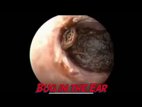 Video: Bug In Ear: Symptomer, Fjernelse, Komplikationer