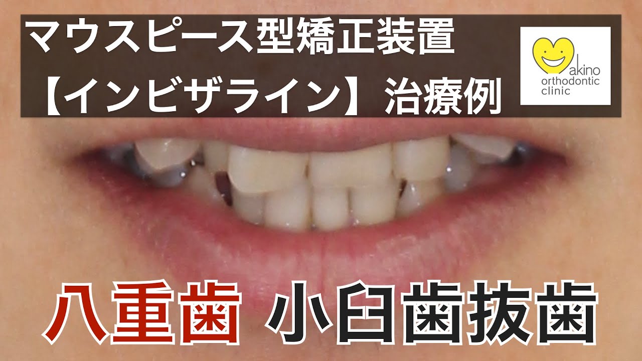 でこぼこ 叢生 の矯正治療例 症例集 千葉県八千代市の矯正歯科専門医院 まきの歯列矯正クリニック