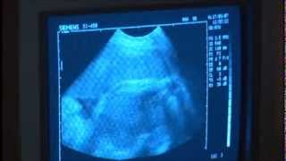 видео Зачем делать КТГ при беременности?