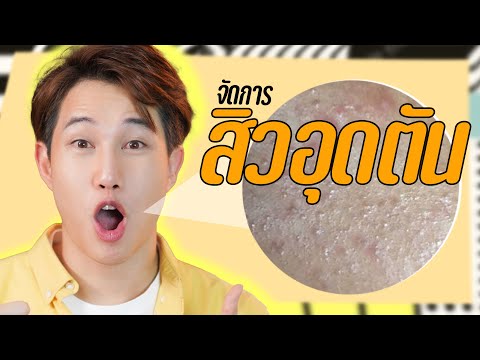 สิวอุดตัน รักษายังไง รักษาสิวด้วยตัวเอง แบบไม่ต้องกดสิว!! | เอามั้ยลองไมค์