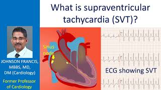 What is supraventricular tachycardia (SVT)?