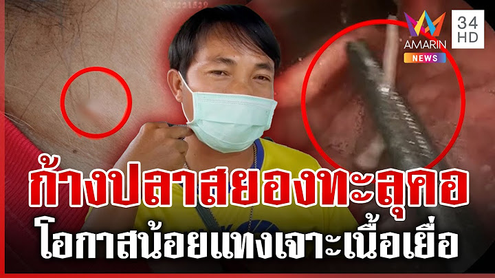 “หมอหมู” ไขคำตอบก้างปลาแทงทะลุคอ ได้จริงหรือไม่ | ทุบโต๊ะข่าว | 17/06/68