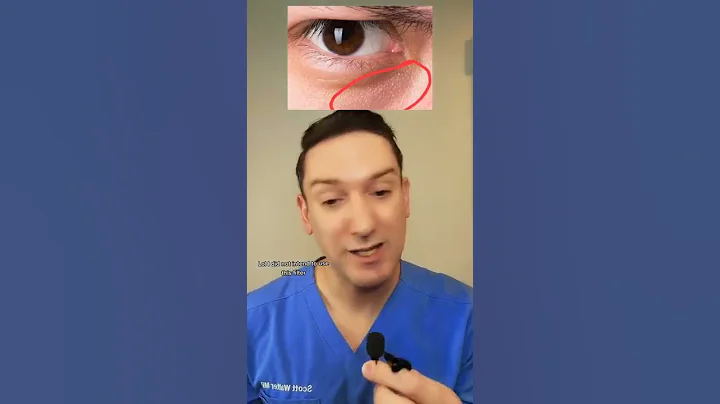 What are those little BUMPs under your eyes?! #undereyebumps #undereye #skinfacts