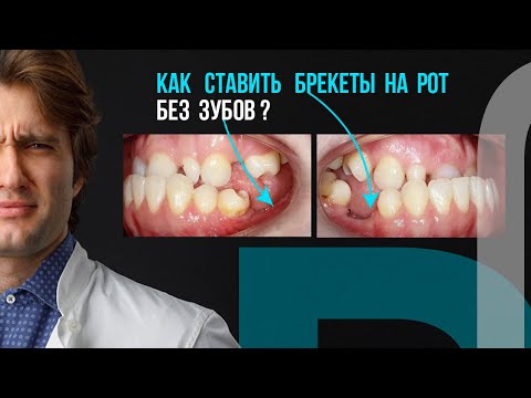 Как же ставить брекеты на беззубый рот❓