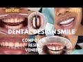 COMPOSITE RESIN VENEERS- MY HUGE TEETH TRANSFORMATION IN MIAMI! DENTAL DESIGN SMILE