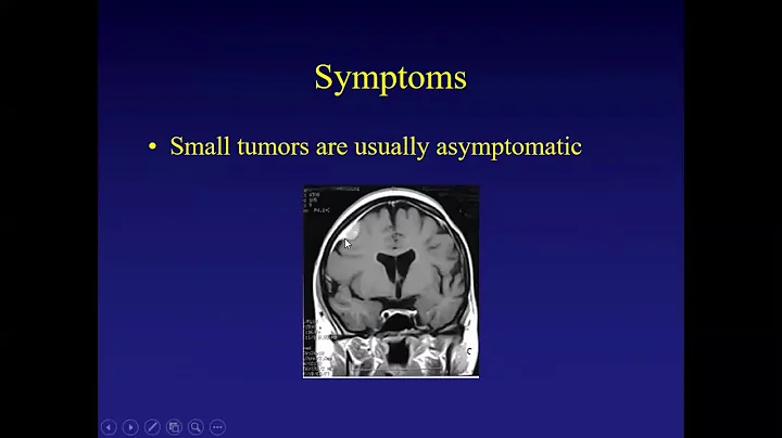 Which Meningiomas Should Not Be Treated by Dr. Ste...