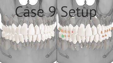 Maestro 3D aligners virtual setup: case 9, fixing an anterior crowding with distalization and IPR