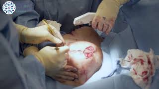 Real Surgery Mastopexy Surgery Surgicare Artsideal Body Insute