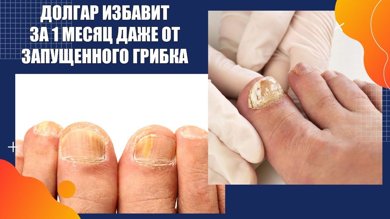 Последнее средство от грибка ногтей