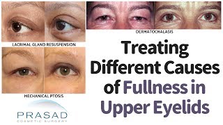 Different Causes of Fullness in the Upper Eyelids or Brow, and How to Treat Them