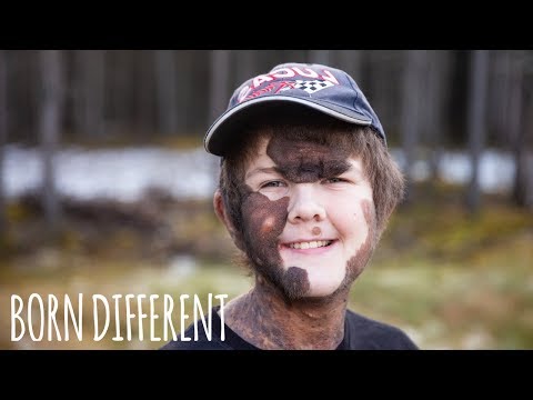 Boy With Giant Mole Beats The Bullies | BORN DIFFERENT