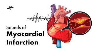 Sounds of Myocardial Infarction