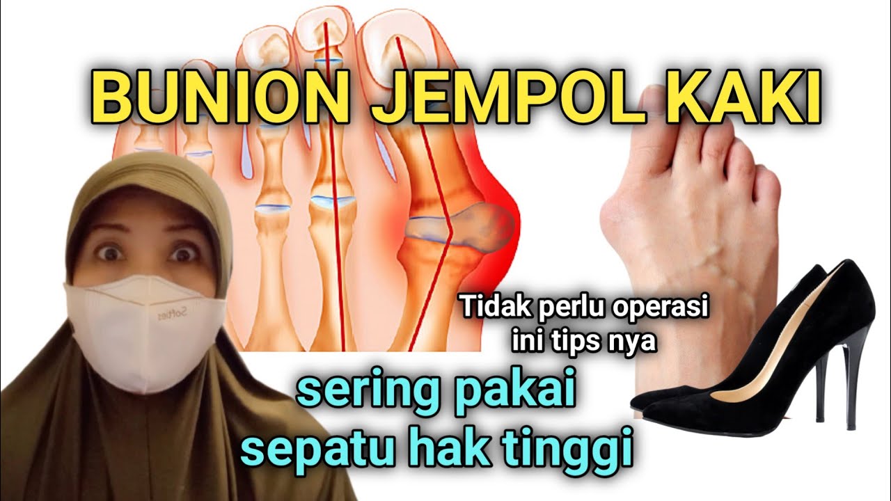 BUNION JEMPOL KAKI BENGKOK KE JARI TELUNJUK - PENYEBAB DAN CARA