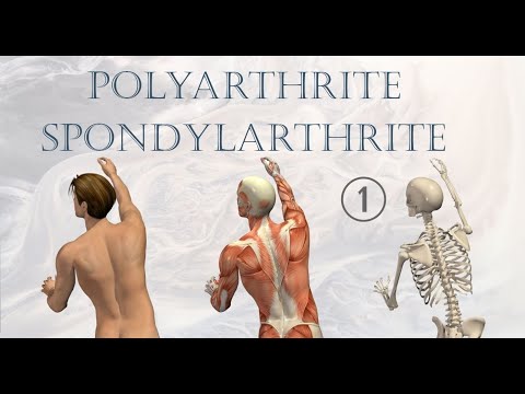 Vidéo: 3 façons simples de traiter la polyarthrite rhumatoïde du coude
