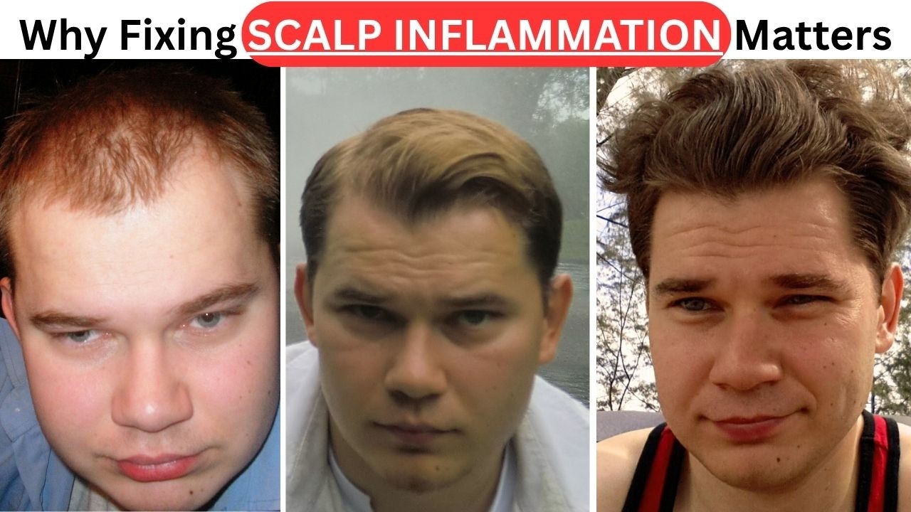 Связь ДГТ с воспалением: НОВАЯ стратегия борьбы с выпадением волос