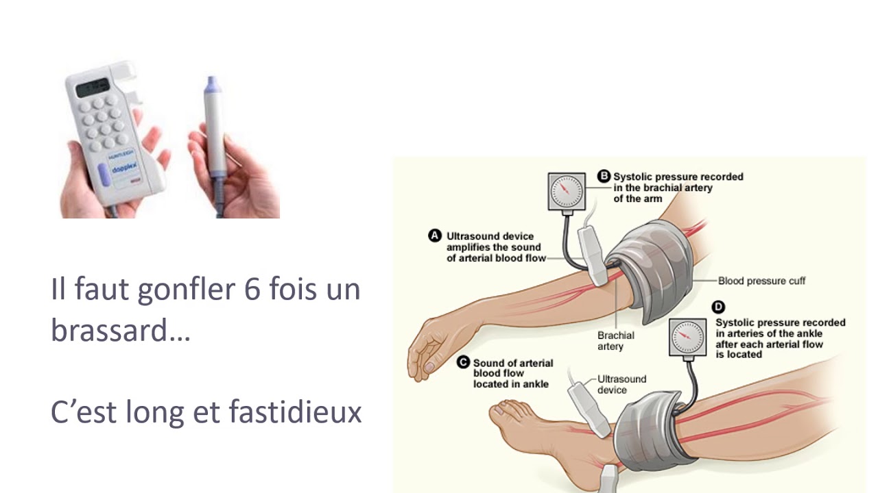 IL FAUT VÉRIFIER LES IPS AVANT DE PRESCRIRE LA COMPRESSION MÉDICALE ...