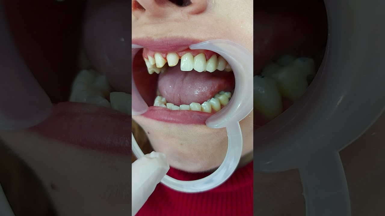 emax kaplama dişlerin prova aşaması  :)