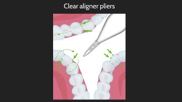 The use of aligner pliers. My lecture from 2020 - Part 7.