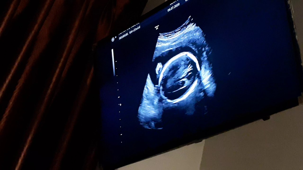 Baby Scan Part 3 YouTube