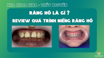 Răng Hô Là Gì? Xem Ngay Hành Trình Niềng Răng Hô Thay Đổi Ngoại Hình | Nha Khoa Hina
