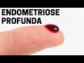 Sintomas da endometriose profunda