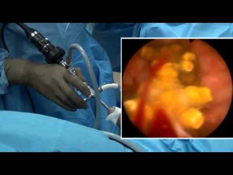 cystoscopy male urethra bladder surgery coming urology come