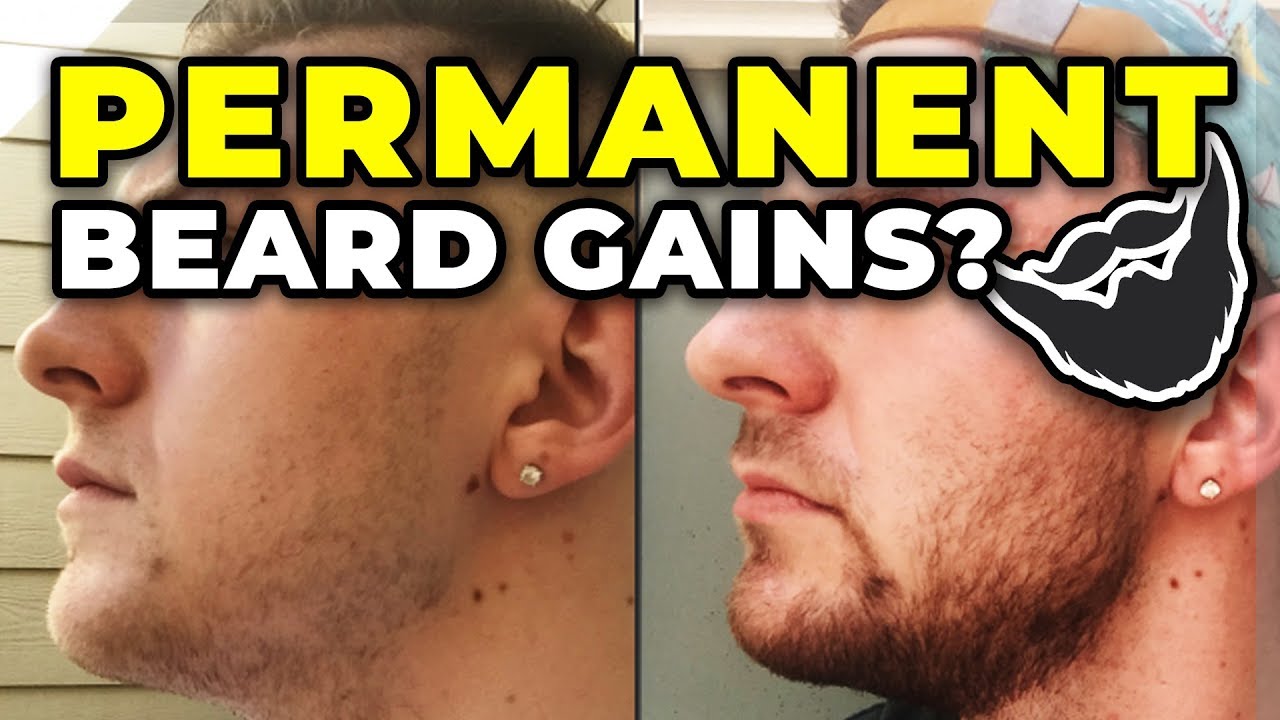 PROOF That Minoxidil Beard Gains Are PERMANENT After Stopping!? YouTube