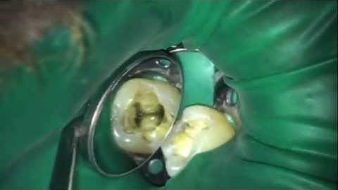 SPECIALIZED ENDO Rotary Glide Path Method