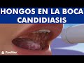 CANDIDIASIS oral y BOQUERAS - Cómo CURAR los hongos de la boca ©