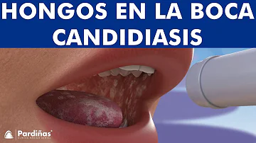 ¿Es letal la candidiasis oral?