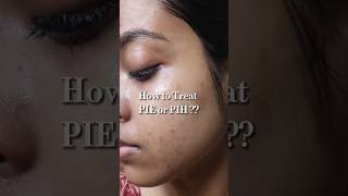 Read the description ✨ PIH & PIE Acne Marks Treatment | Dark Spots, Hyperpigmentation Skincare #acne