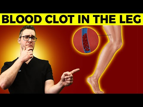Blood Clot in