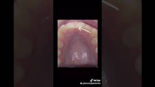 What's a Deep Bite or Over Bite