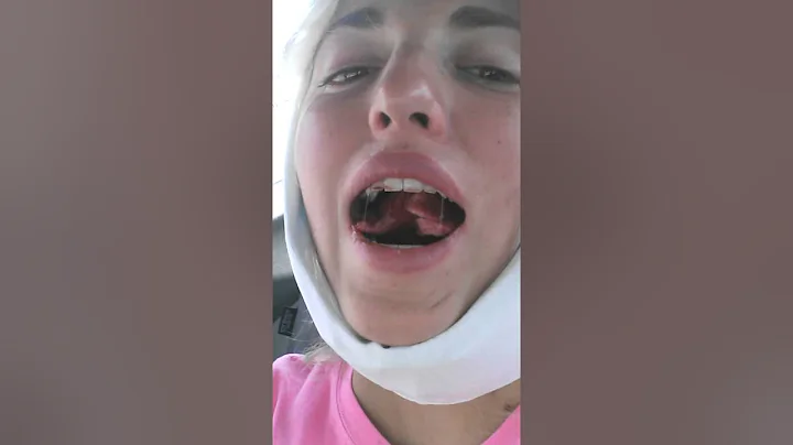Miranda's (Irmanda) wisdom teeth experience