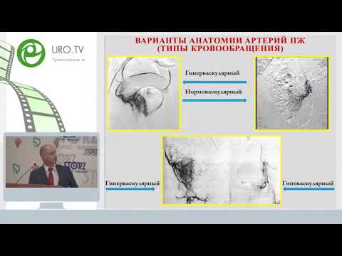 Курбатов Д Г   Эндоваскулярная эмболизация при аденоме простаты